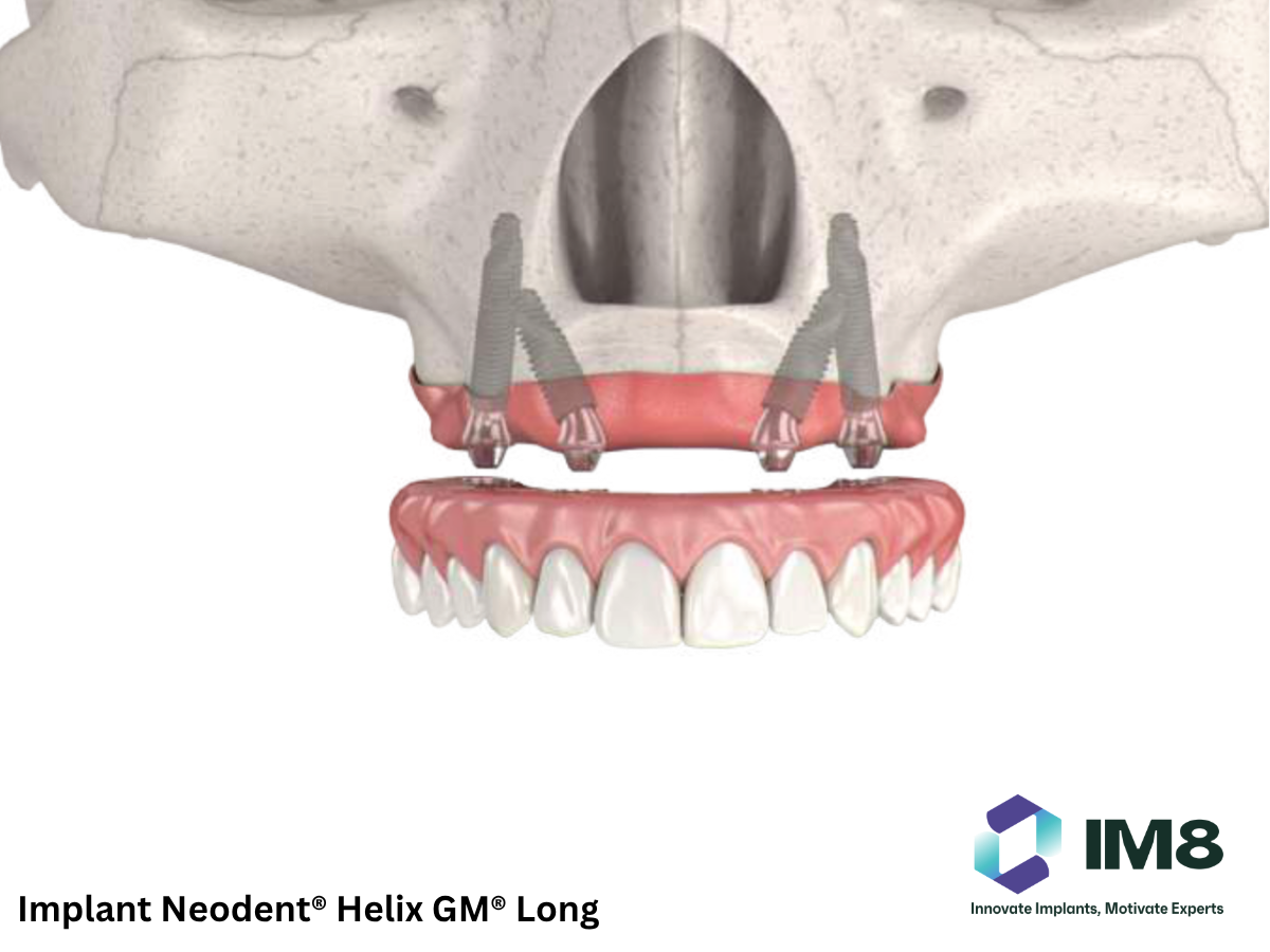 Implant Neodent® Helix GM® Long 2